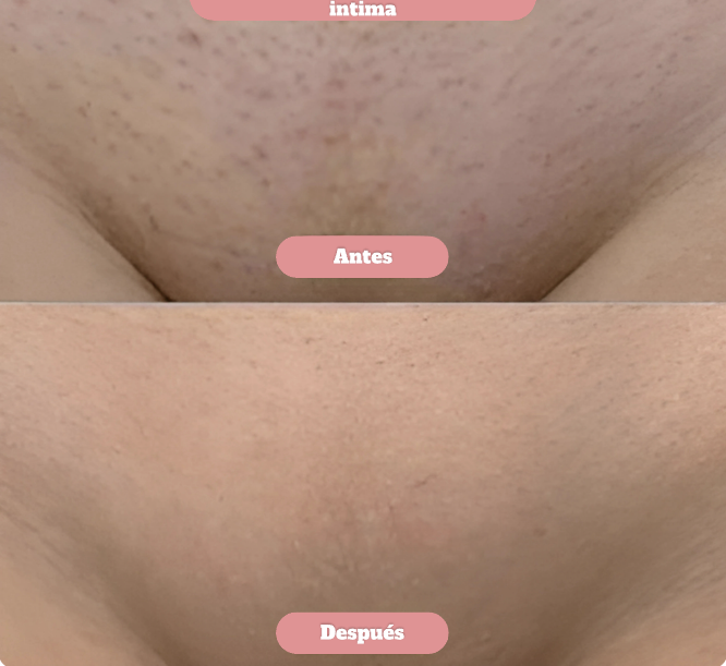 SilkyGlow﻿: depiladora femenina 2 en 1